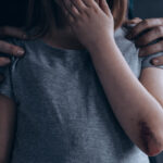 Closed-up of child with bruises on her elbow that represents as the header of "sexual penetration of a child charges" blog.